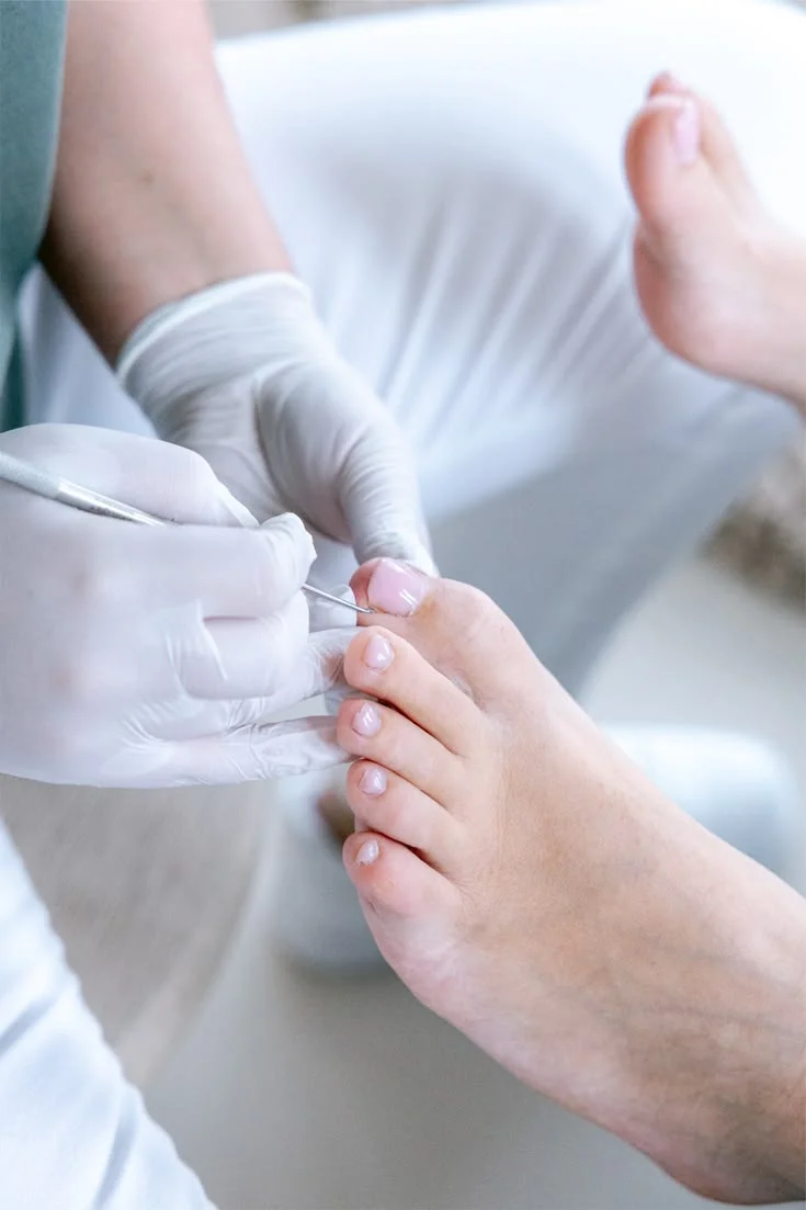 cách lấy khóe móng chân không đau